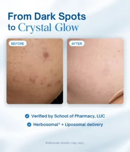 Lipo Crystal dark spot before and after