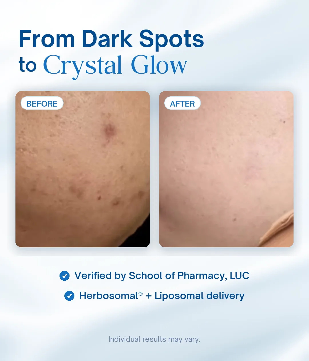 Lipo Crystal dark spot before and after — from dark spots to crystal glow
