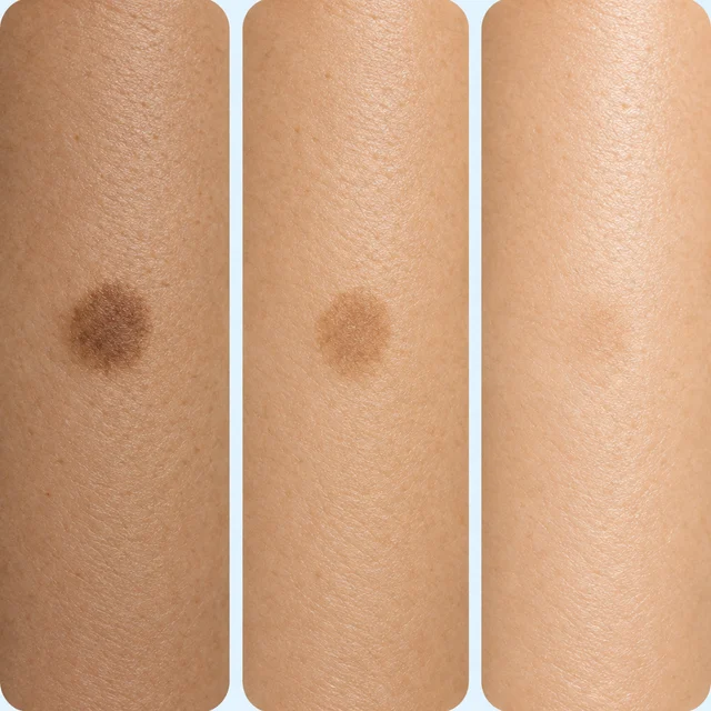 Three strips of skin, each with one dark spot, fading from dark to almost invisible