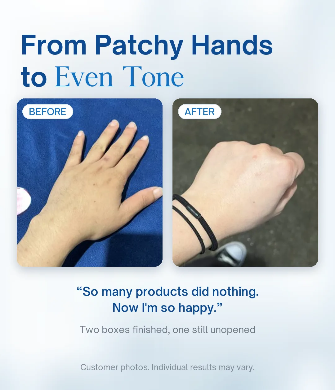 Lipo Crystal customer hand pigmentation before and after, from patchy hands to even tone